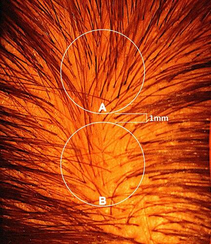 Figure 1 A photograph of a male vertex in the early stages of AGA. Zones represent potential biopsy locations separated by approximately 1 mm. Zone A features relatively high hair counts, low HDD, and terminal hair follicles skewed toward earlier cycles of HFM. Zone B features relatively low hair counts, high HDD, and terminal hair follicles skewed toward later cycles of HFM.