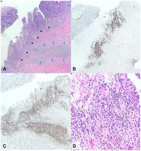 Figure 3 (A) H&E stain; 4x; Colon containing residual carcinoma with lymphocytic infiltrate within tumor (black arrowheads) and area of treatment effect (blue arrows). (B) CK7 IHC stain; 40x; CK7 stain highlighting residual carcinoma within colonic mucosa. (C) CD3 IHC stain; 40x; IHC stain highlighting CD3+ lymphocytes within tumor and area of treatment effect. (D) H&E stain; 400x; High power view of residual carcinoma within the colon with numerous tumor infiltrating lymphocytes.