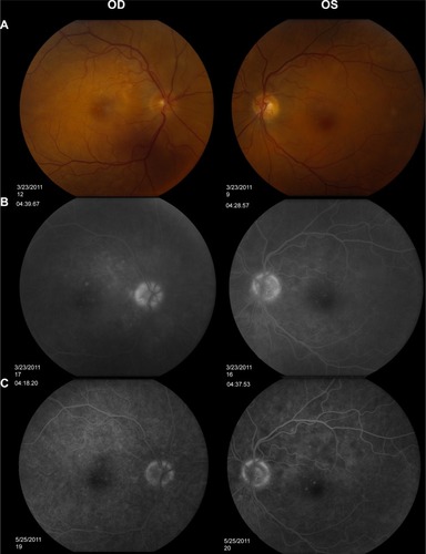 Figure 6 Fundus photos and FA studies of Case 3.