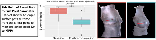 Figure 8. The side point of breast base to bust point symmetry significantly decreased (became more asymmetrical) for the participants who underwent unilateral implant-based reconstruction (p < 0.001). (A) Boxplot of symmetry at baseline and post-reconstruction (median and interquartile range). (B) The side point of breast base to bust point measurement on an exemplar patient. (C) The side point of breast base to bust point measurement on the same patient post-reconstruction.