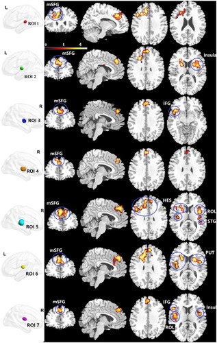 Figure 5 Clusters showing between-group RSFC differences of the thalamic subregions. Significance level was defined at voxel p < 0.005, cluster p < 0.05, GRF corrected. R refers to the left side of the image in the coronal and horizontal sections corresponding to the left side of the brain.