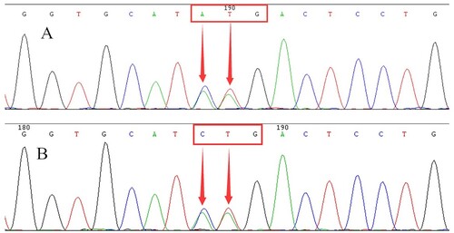 Figure 4. DNA sequencing of the proband (A) and his baby (B). They revealed a heterozygous CTG>AAG mutation at codon 3 of the β-globin gene (arrow).