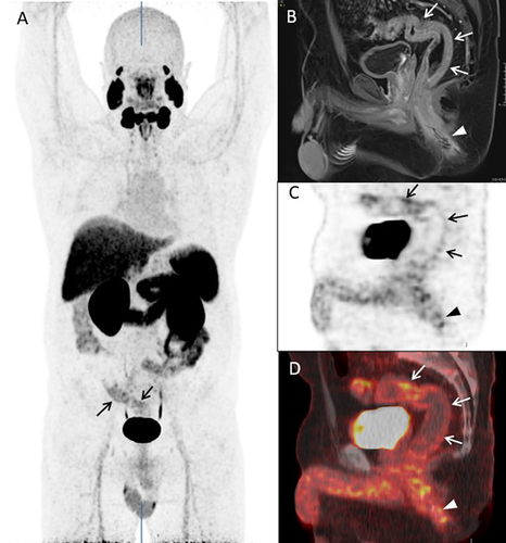 Figure 5 Abnormally increased [18F]DCFPyL uptake in the sigmoid colon and rectum on PET/CT. (A) [18F]DCFPyL PET/CT uptake in the sigmoid colon (identified by the arrows and arrowheads) on a coronal plane. (B) Axial CT Image with arrows identifying active inflammation in the sigmoid colon and rectum. (C) Axial PET Imaging arrows identifying active inflammation in the sigmoid colon and rectum. (D) Axial [18F]DCFPyL PET/CT fusion imaging with arrows identifying active inflammation in the sigmoid colon and rectum.