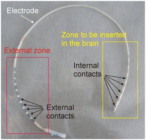 Figure 1. Example of SEEG electrode consisting of metal contacts joined in pairs. The internal contacts are inserted in the brain, while the external contacts are accessible for mapping, stimulation or applying RF power.