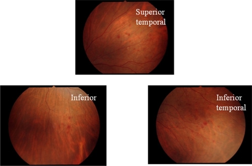 Figure 1 The retinal hemorrhage is observed over three quadrants in the fundus just after disappearance of the 20% SF6 gas.