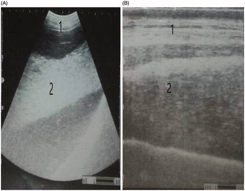 Figure 2. Ultrasonography of an abdominal cavity showing hypoechoic material represented as pus (suppurative peritonitis) by a convex transducer (A) and a linear transducer (B). 1. Abdominal wall. 2. Hypoechoic material (pus).