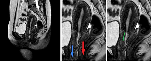Figure 2 Sagittal T2 shows the MRI anatomy of the cervix. Hyperintense T2 endocervical canal, and hypointense T2 fibrous stroma, the thin posterior lip of the cervix. The blue arrow represents the anterior lip of the cervix, the red arrow represents the posterior lip of the cervix, and the green line represents longitudinal diameter of cervical canal.