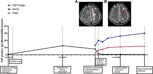 Figure 1 Timeline for Case 1. (A) Axial cerebral magnetic resonance imaging (MRI) in T2-weighted sequences before lenalidomide treatment: the red arrow shows left frontal lobe hyperintensity. (B) Axial cerebral MRI: the red arrow shows the left frontal lobe lesion signal disappeared after lenalidomide treatment.