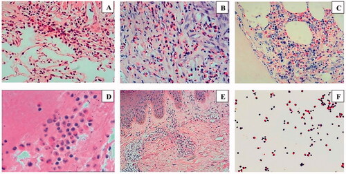 Figure 2. Pathological examination image (HE staining). (A) Infiltration of eosinophils and lymphocytes in lung interstitium (magnification: ×200). (B) Pleural tissue shows many eosinophils infiltrated in the fibrous connective tissue (magnification: ×200). (C) Pronounced eosinophil infiltration in bone marrow tissue (magnification: ×200). (D) EOS infiltration is seen in mediastinal lymph nodes (magnification: ×400). (E) EOS infiltration in the skin tissue of the right lower limb (magnification: ×100). (F) EOS in pleural effusion smears (×200). HE, haematoxylin and eosin; EOS, eosinophils.