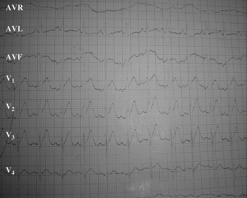 Fig. 3. Electrocardiogram in admission of the second patient showing ST-segment elevated in leads V1, V2, and V3.