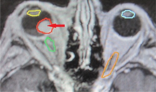 Figure 1 MRI of a patient with posterior uveal melanoma: arrow + red color indicate tumor mass, yellow and blue colors indicate lens, and green and orange colors indicate optic nerves.