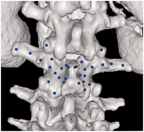 Figure 1. 3D visualization of the vertebra used in the experiments. The dots are examples of points selected on the surface of the vertebra that will be used to generate PCpatient. Blue dots are points visible from the current viewing direction, and black dots are those occluded by the tip of the spinous process.