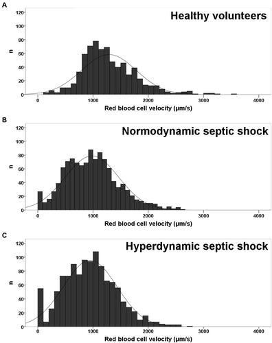 Figure 4 Histograms of capillary red blood cell (RBC) velocities. (A) Healthy volunteers. (B) Patients with normodynamic septic shock. (C) Patients with hyperdynamic septic shock. Reproduced with permission of the Americal Thoracic Society. Copyright © 2016 American Thoracic Society. All rights reserved. Edul VS, Ince C, Vazquez AR, et al. Similar Microcirculatory Alterations in Patients with Normodynamic and Hyperdynamic Septic Shock. Ann Am Thorac Soc. 2016;13(2):240–247).Citation36 Annals of the American Thoracic Society is an official journal of the American Thoracic Society.