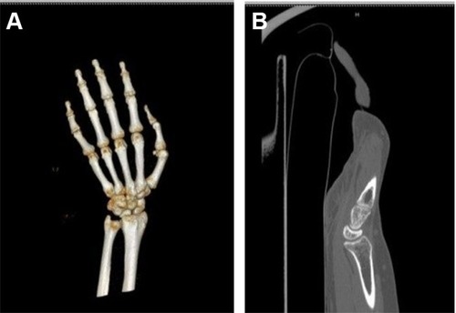 Figure 2 3DCT scan (A) and 2D sagittal view CT scan (B) show no recent bone injury identified.