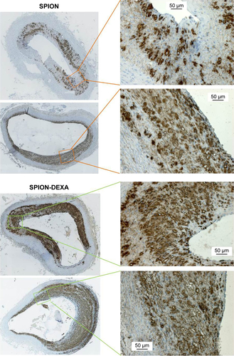 Figure S2 In vivo effects of early MDT with SPION-DEXA on macrophage load.Notes: Following the balloon injury, the animals were intraarterially administered either control SPION (n=5) or SPION-DEXA (n=4) under external magnetic field. After 5 weeks of high-cholesterol diet and normal diet for 2 weeks, animals were sacrificed and the excised aortas analyzed histochemically. Mouse monoclonal antibody against rabbit macrophages (RAM-11, 1:50 dilution) was used to detect plaque macrophages. Digital images of the plaques at ×10 objective magnification (left, overview images) or 20× objective magnification (right) were obtained using AxioObserver.Z1 microscope. The representative example images from two different animals per each group show macrophage accumulation in the atherosclerotic plaques.Abbreviations: MDT, magnetic drug targeting; SPION, superparamagnetic iron oxide nanoparticle; SPION-DEXA, SPIONs conjugated with dexamethasone phosphate; THP-1, a human monocytic cell line.