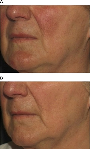 Figure 1 Facial erythema and prominent telangiectasias in a patient with rosacea before (A) and after two 595 nm pulsed dye laser (PDL) treatments (B).