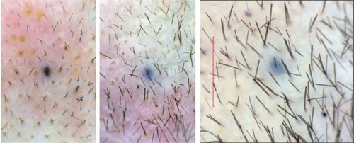 Figure 6 Baseline (left) versus 6-week (middle) versus 24-week (right) macrophotograph of the patient in Figure 5.