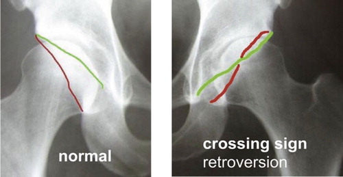 AP radiograph with the anterior (green line) and posterior (red line) wall of the acetabulum.