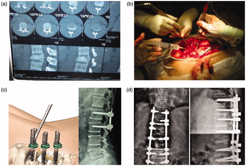 Figure 2. Surgical procedure of pedicle screw fixation.