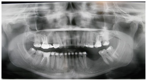 Figure 2 Possible spreading of the bacterial process from improper endodontic treatment of tooth 16.