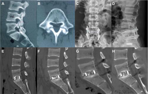 Figure 5 Images were obtained from a 48-year-old male patient with the degenerative spondylolisthesis at L5-S1. (A and B) Sagittal and axial CT images showing degenerative spondylolisthesis at L5-S1; (C and D) Postoperative anteroposterior and lateral X-rays images showing correct cage and pedicle screws after full Endo-PLIF; (E–H) Postoperative sagittal CT images at 3, 6, 9, 12 months showing interbody fusion.