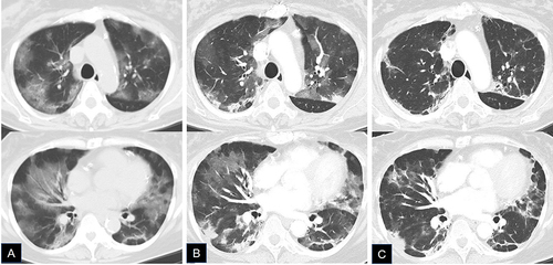 Figure 1 Computed tomography. (A) day 13; (B) day 19; and (C) day 37, after symptom onset. Upper images show upper lobes, and lower images show lung bases where ground glass opacities and consolidations appeared predominant.