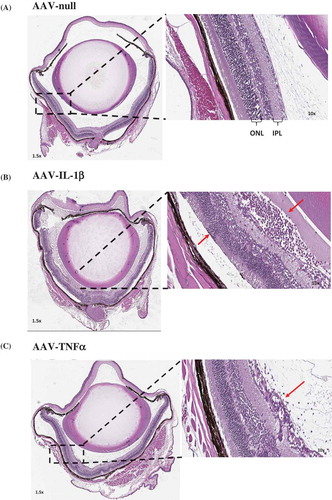 Figure 3a. Eye histopathology following AAV–IL-1β and AAV–TNF-α IVT injection. H&E staining of the whole eye showing no cellular infiltrates in (A) the AAV-null injected eye and a markedly increased number of cellular infiltrates (red arrows) in (B) AAV–IL-1β-injected eye and in (C) AAV–TNF-α-injected eye albeit to a lesser extent. (D) The thickness of the mouse retina was measured in 4–5 sites as shown in the picture. (E) Each symbol represents the average thickness of one retina in each experimental group (n = 4). (F) The average thickness of the different retinal layers in the same eyes. Cellular infiltrates in (G) retina close to the optic nerve head and in (H) areas around the ciliary body in AAV–IL-1β-injected eye (red arrows) and not in the AAV-null injected eye. Mice were injected IVT with 5 × 108 vg/eye, and 5 weeks later eyes were collected for analysis. Histology pictures are representatives of four animals per experimental group.