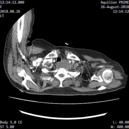 Figure 3 CECT neck showing peripheral enhancing hypodense area in the prevertebral space compressing trachea and oesophagus.