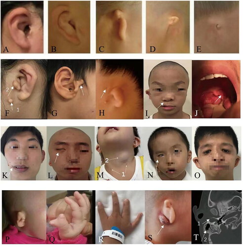 Figure 3. Congenital malformation of the middle and outer ear (CMMOE). (1) (A–E) Microtia grades I–V, (2) F-R: multiple malformation including CMMOE, (F) 1 accessory ear, and 2 (G) tragus deformity, (H) preauricular fistula, (I) cleft lip (after repaired), (J) soft palatine tonsil deformity, (K) hemifacial microsomia and large mouth deformity, (L) facial paralysis, (M) 1 cervical branchial fistula and 2 abscess (cyst), (N) Goldenhar syndrome (showing microtia, keratodermoid, torticular neck, etc.), (O) Treacher-Collins syndrome (showing microtia, eye cleft down oblique, mandibular dysplasia, etc.), (P–R) microtia with polydactyly/oligodactyly, and (S, T) CMMOE with infection. S: retroauricular abscess, T: 1 outer ear canal cholesteatoma and 2 mastoiditis.