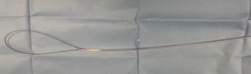Figure 3 A photograph of the Urethrotech catheterisation device showing the guidewire, which had doubled back and entered the main drainage channel of the three-way Foley catheter.