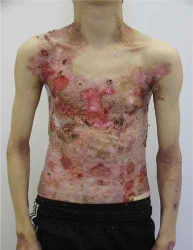 Figure 9 Appearance of lesions on the patients chest and abdomen on day 1 after discharge.