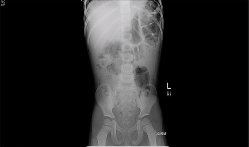Figure 1 Abdominal X-ray.