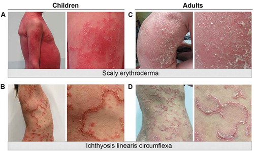 Figure 1. Clinical features of Netherton syndrome. Images of children (A-B) and adults (C-D) with scaly erythroderma or ichthyosis linearis circumflexa. Panels to the right are close-ups of affected skin areas for each patient