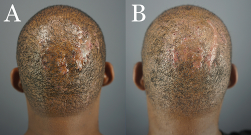 Figure 8 Patient 5 with FD plaque involving the right parietal prominence area before surgical excision. (A) and nine months after complete excision of the FD lesion and healing by second-intention, aided by guarded high-tension sutures (B).