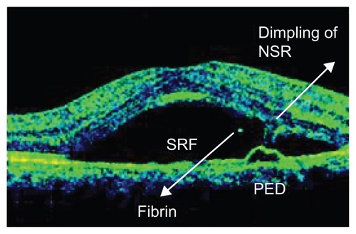 Figure 3 The presence of a pigment epithelial detachment (PED), dimpling of the neurosensory retina (NSR), and fibrin in the area of the subretinal fluid (SRF).