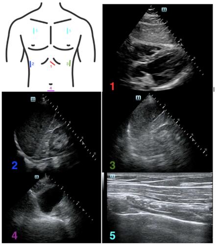 Figure 2 Location on the chest where the (1) subxiphoid, (2) right upper quadrant, (3) left upper quadrant, (4) pelvic, and (5) apical lung views are obtained, with corresponding sonographic images.