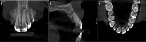 Figure 20. CBCT scan showing severe calcification and an apical lesion.
