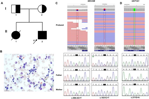 Figure 1. (A) Pedigree of the proband with congenital dyserythropoietic anemia II. (B) Bone marrow smear of the proband revealed erythroid hyperplasia, binucleation of erythroblasts (green arrows), dysplastic, and multilobulated (red arrows) erythroid precursors (Wright-Giemsa stain, x 400). (C) Integrative Genomics Viewer (IGV) snapshot showing the likely pathogenic variants of SEC23B gene in the proband. Sanger sequencing confirmed compound heterozygous variants (NM_006363.6:c.994-3C > T and c.1831C > T) in the gene. (D) IGV snapshot showing the homozygous UGT1A1*6 allele in the proband. Sanger sequencing of family members showing UGT1A*6 heterozygosity and homozygosity in his father and mother, respectively.