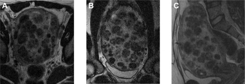 Figure 3 Example of MRgFUS screen failure due to innumerable small fibroids.