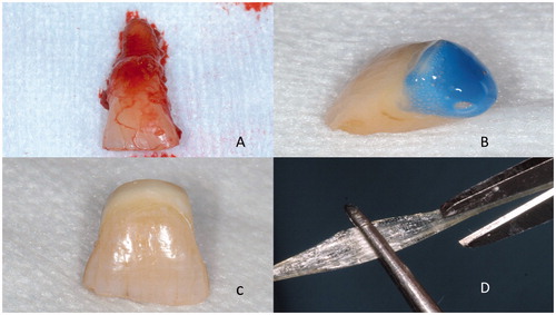 Figure 2. Extracted tooth (A) is cut and veneered from the cutting surface with resin composite (B) to make a pontic (C) for being attached to the adjacent teeth with continuous unidirectional glass fibers (C).