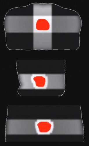 Figure 3.  Computed patient dose distribution in the axial (top), sagittal (middle) and coronal (bottom) plane, respectively. For clarity, only the CTV and the external patient contour are shown. A treatment margin of 10 mm was used. Notice the MLC field shaping.