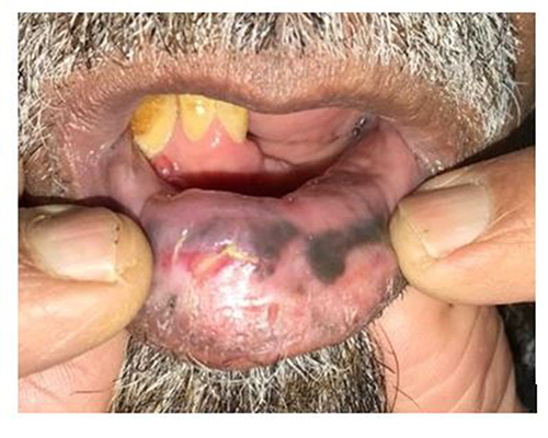 Figure 1 Clinical photograph showing gray pigmentation on the lower labial mucosa with ulceration.