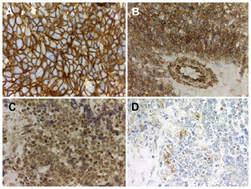 Figure 2 (A) Strong CD99 immunoexpression with predominant membranous pattern in Ewing sarcoma, 40×. (B) Strong caveolin 1 immunoexpression in Ewing sarcoma, 40×. (C) Fli-1 nuclear expression in Ewing sarcoma, 20×. (D) HNK-1 cytoplasmic positivity in Ewing sarcoma, 20×.