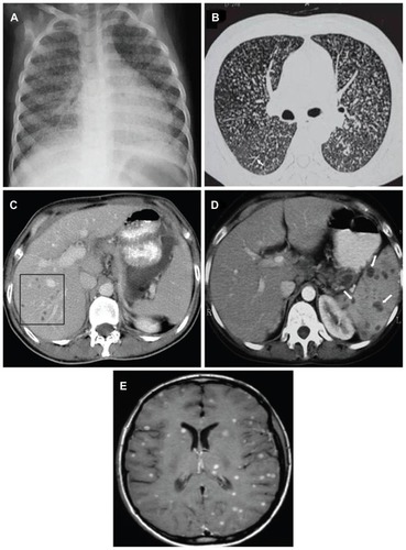 Figure 3 (A) Chest radiograph (posteroanterior view) showing classical miliary pattern. (B) High-resolution computed tomography image (1.0 mm section thickness) shows uniform-sized small nodules randomly distributed throughout both lungs. Note the classical “tree-in-bud” appearance (white arrow). (C) Contrast-enhanced computed tomography of the abdomen, showing focal miliary lesions in the liver (square) and (D) spleen (white arrows). (E) Miliary central nervous system tuberculosis.