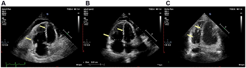 Figure 2 Transthoracic echocardiography. The four cavity heart section views are shown at (A) the first admission, (B) 5 months after discharge (10 months after dasatinib withdrawal) and (C) 12 months after discharge (17 months after dasatinib withdrawal). The arrows showed that enlargement of right ventricle and atrium was gradually restored, as well as the left transposition of the septum and compression of the left ventricle.