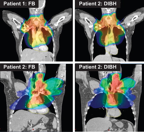 Figure 1. Volume receiving 20 Gy or more with free breathing (FB) and deep inspiration breath-hold (DIBH) in a patient treated with conventional parallel opposing fields (upper panel) and a patient treated with intensity-modulated radiotherapy (lower panel). These coronal views illustrate that the lung volume increases with DIBH and that the heart is pulled caudally with deep inspiration. This results in lower radiation doses to the lungs and heart.