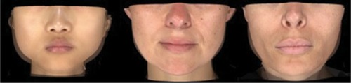 Figure 7 Baseline and visit 3 (week 16) photos superimposed, for three patients treated with incobotulinumtoxinA for masseter hypertrophy.