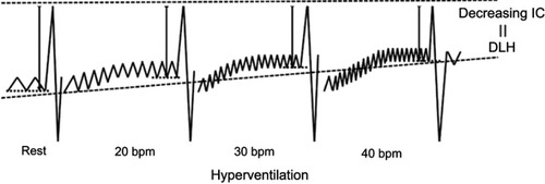 Figure 1 Method for measuring dynamic lung hyperinflation by hyperventilation.Abbreviations: IC, inspiratory capacity; bpm, breaths/min; DLH, dynamic lung hyperinflation.