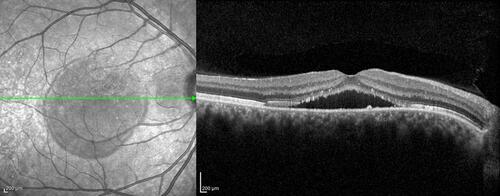 Figure 1 A spectral domain optical coherence tomography image of an eye affected by acute central serous chorioretinopathy showing a convex-shaped blister of fluid separating the neurosensory retina from the retinal pigment epithelium and choroid.