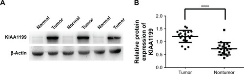 Figure 3 (A) Representative images of KIAA1199 protein expression in HCC tissues and paired normal tissues from three patients. (B) Western blot analysis of KIAA1199 expression in 20 pairs of HCC tissues and matched adjacent normal tissues.